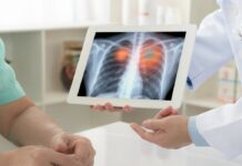 Cancro do Pulmão tira 12 vidas por dia em Portugal